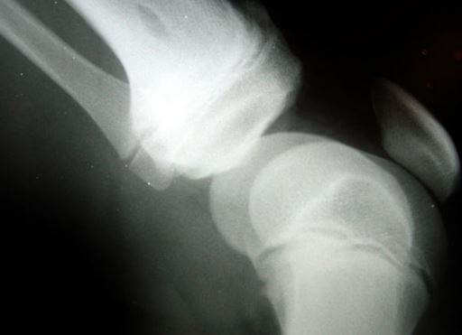 Knee Injury in Car Accident