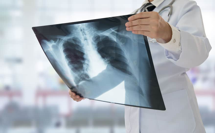 doctor looking at a chest x-ray