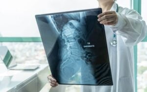 doctor looking at a spinal xray of a patient injured in an accident