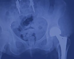 x ray of a hip