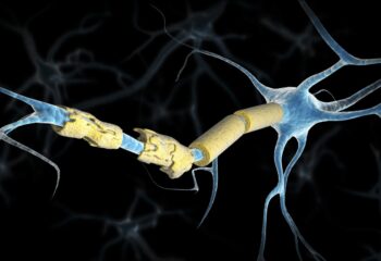 Can Car Accidents Cause Multiple Sclerosis?