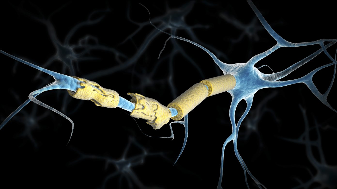 Can Car Accidents Cause Multiple Sclerosis?