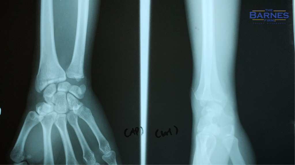 X-Ray Image of dislocated arm